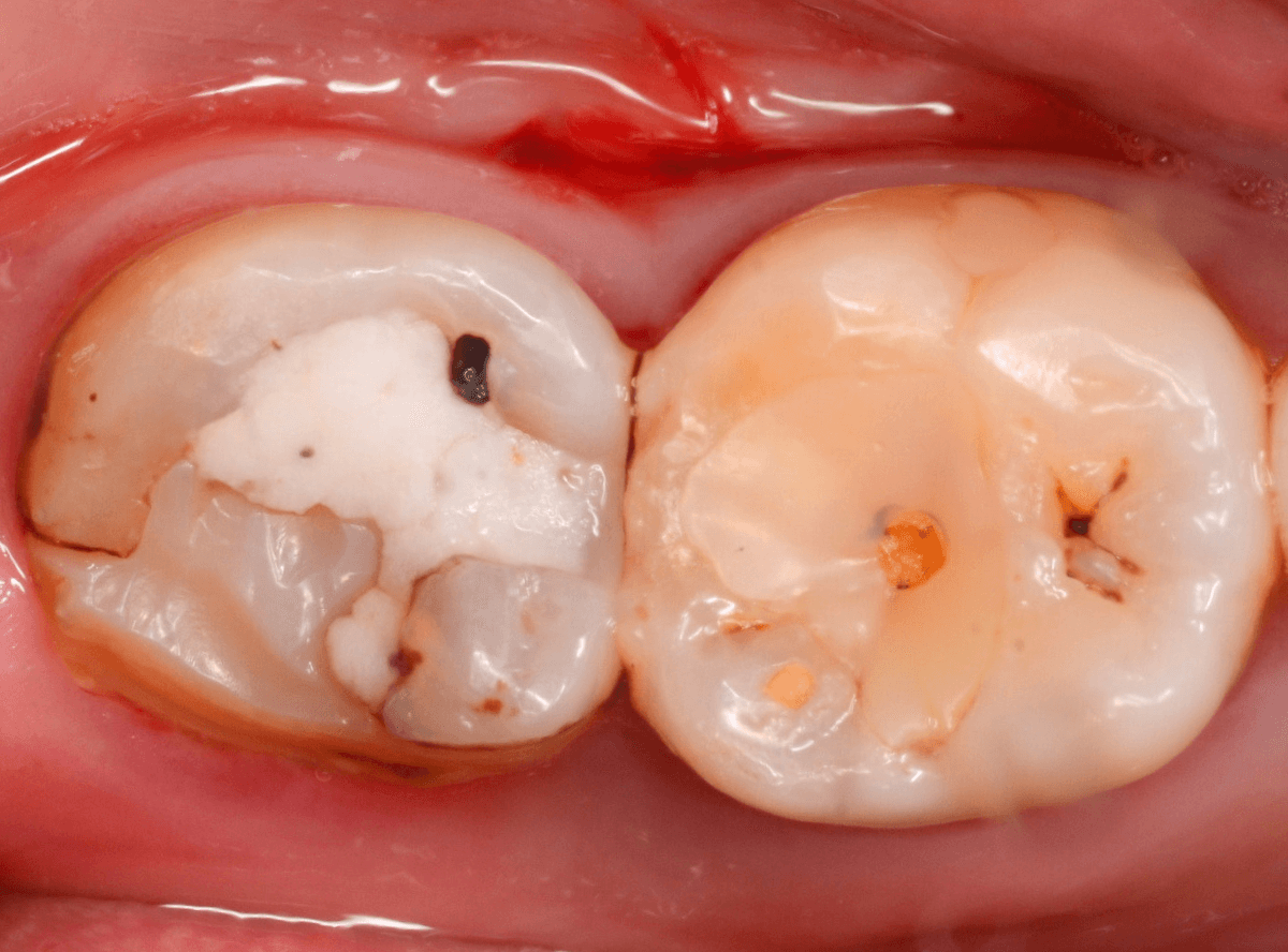 つめものの下の深い深い虫歯11-1