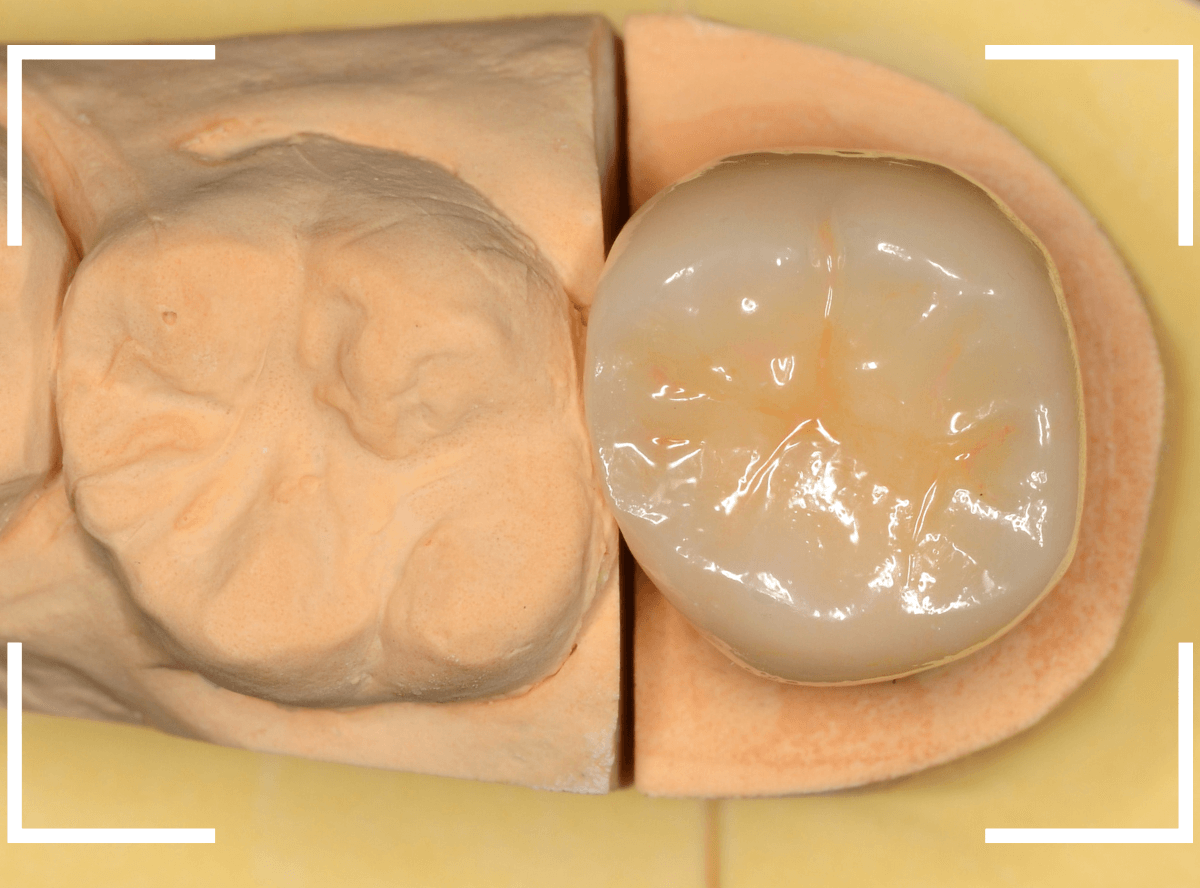 セラミック治療(クラウン・奥歯)10-6