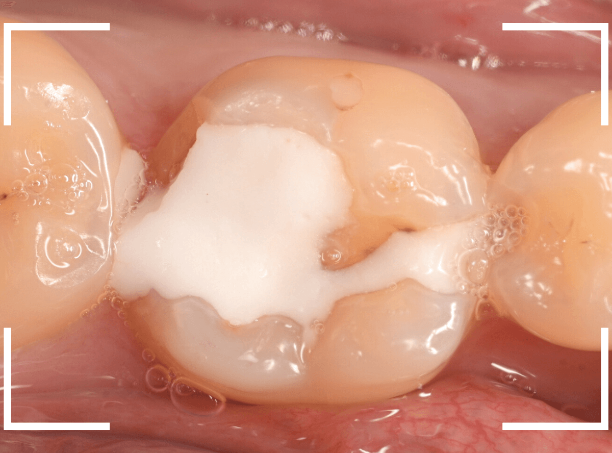 セラミック治療(インレー)29-1