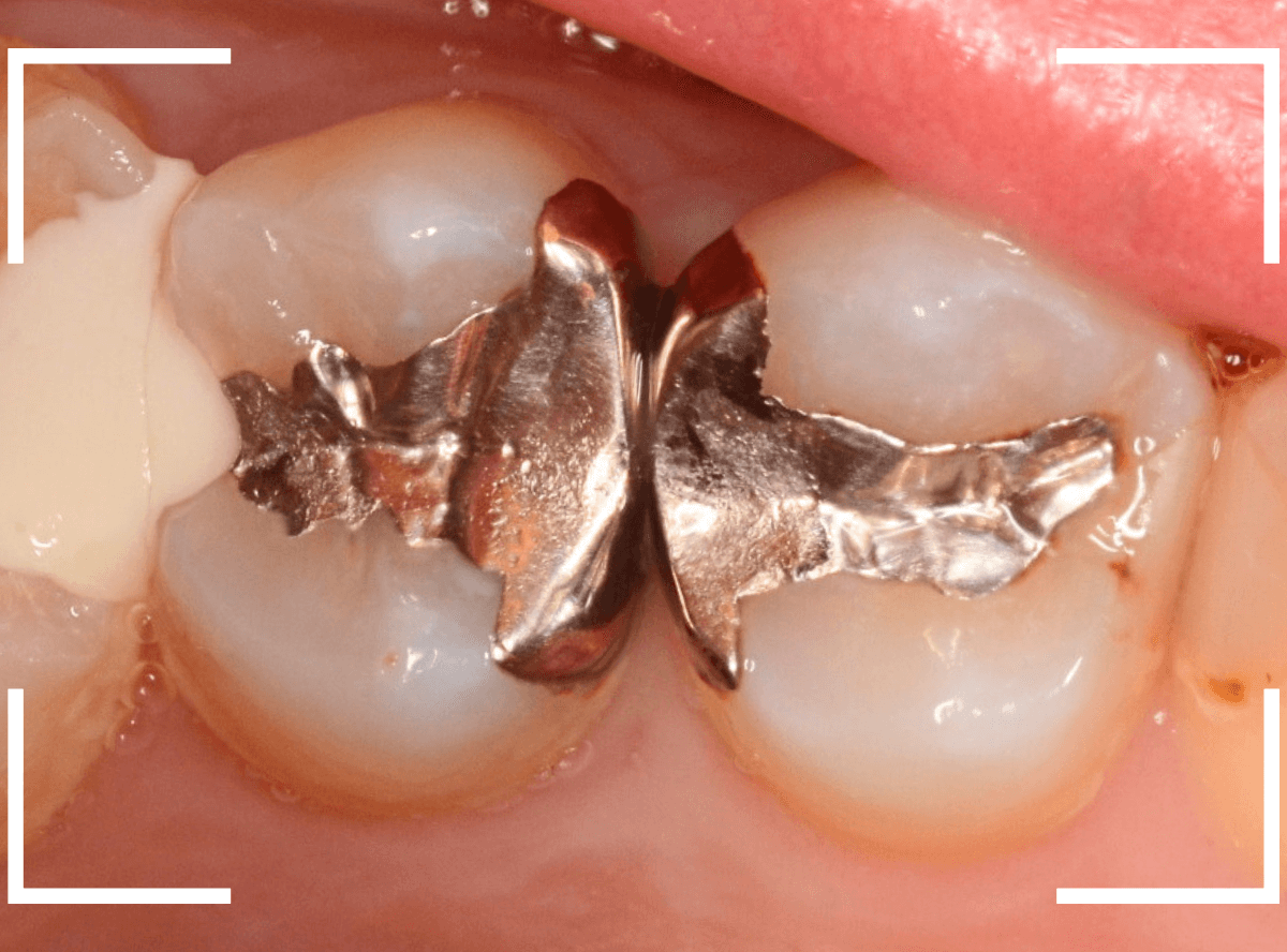 つめものの下の深い虫歯(画像)10-1