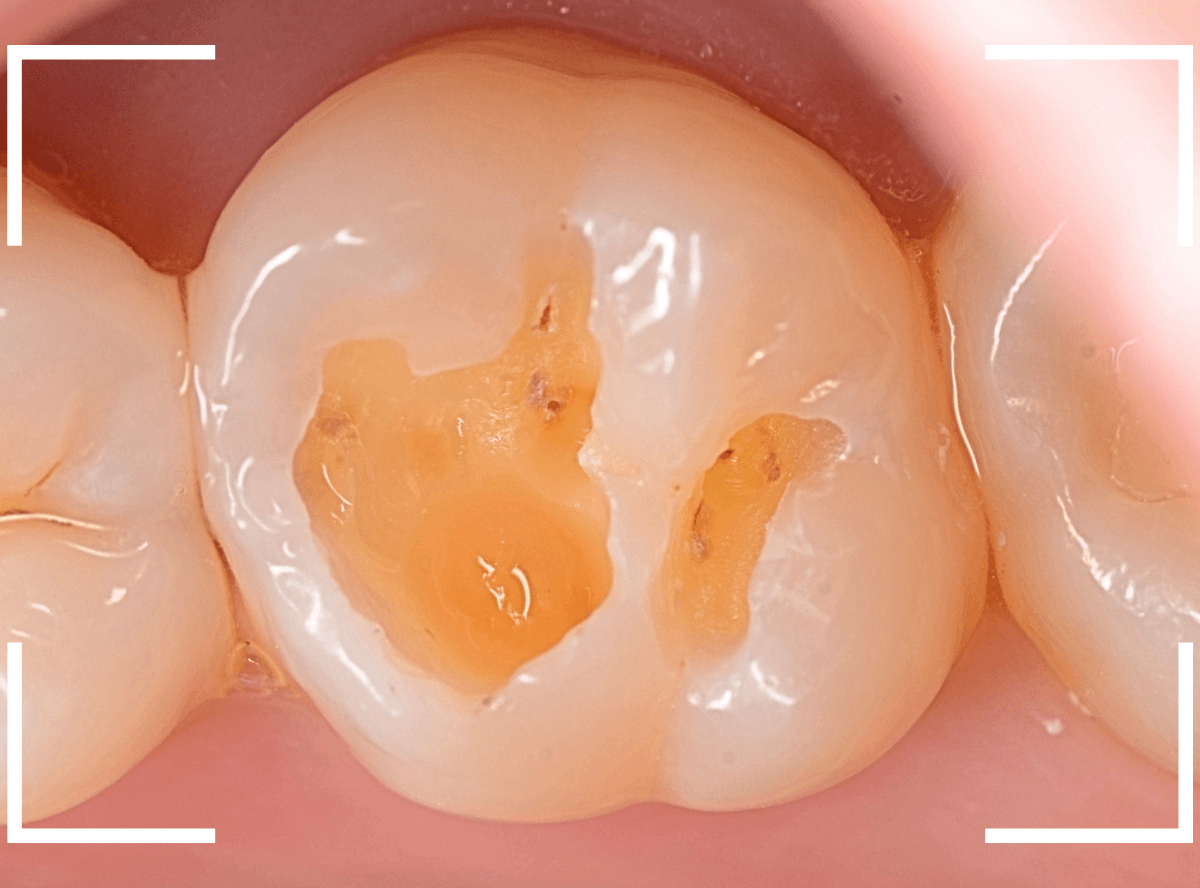 レントゲンでわかりづらい虫歯8-4