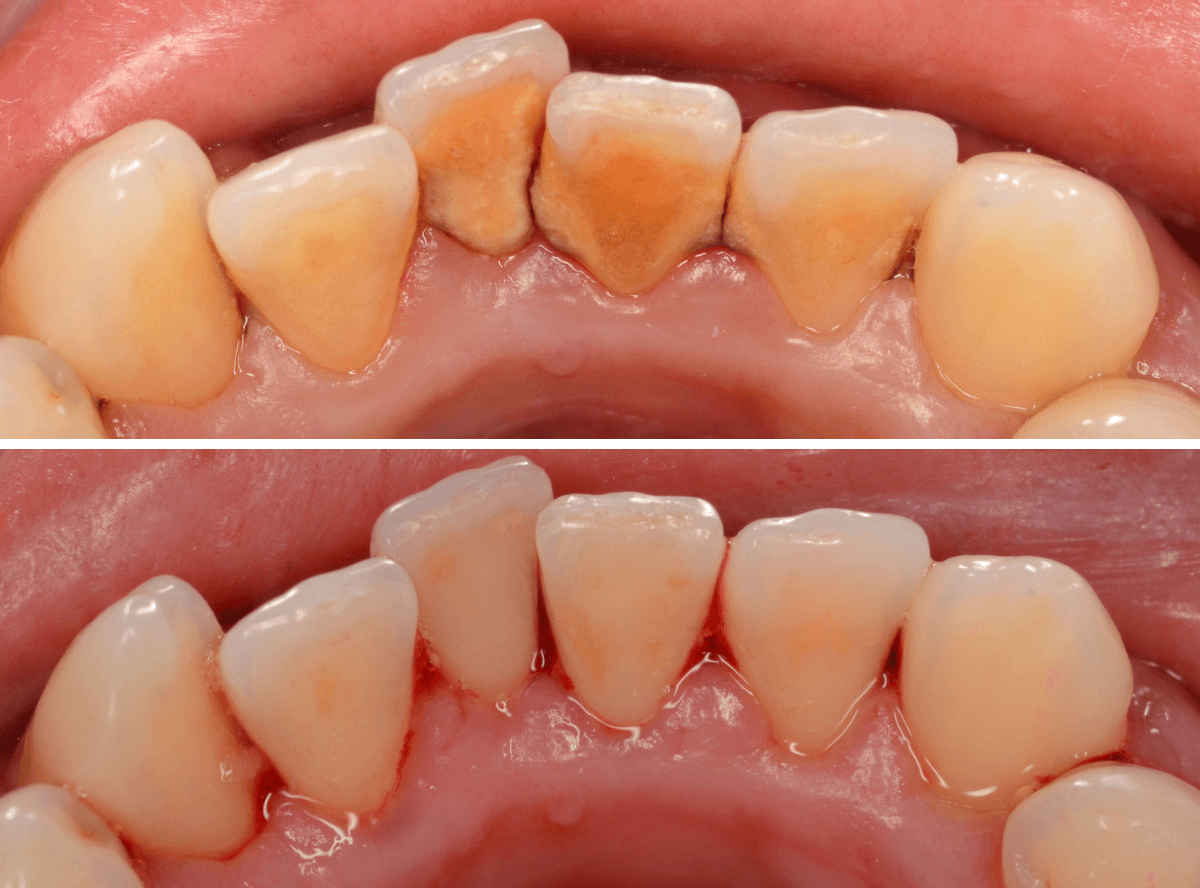 歯肉の中の歯石（歯肉縁下歯石）除去(画像）4-6