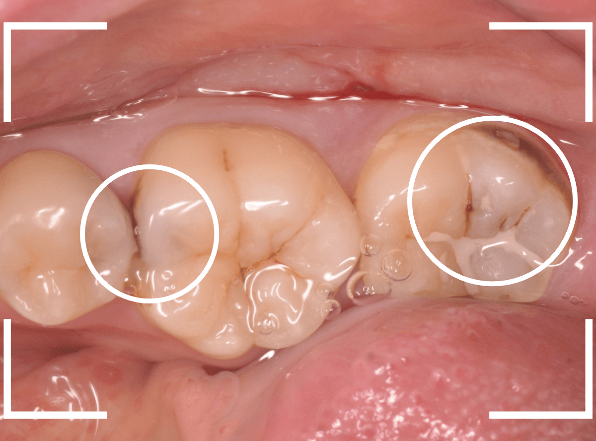 セラミック治療(インレー)30-1