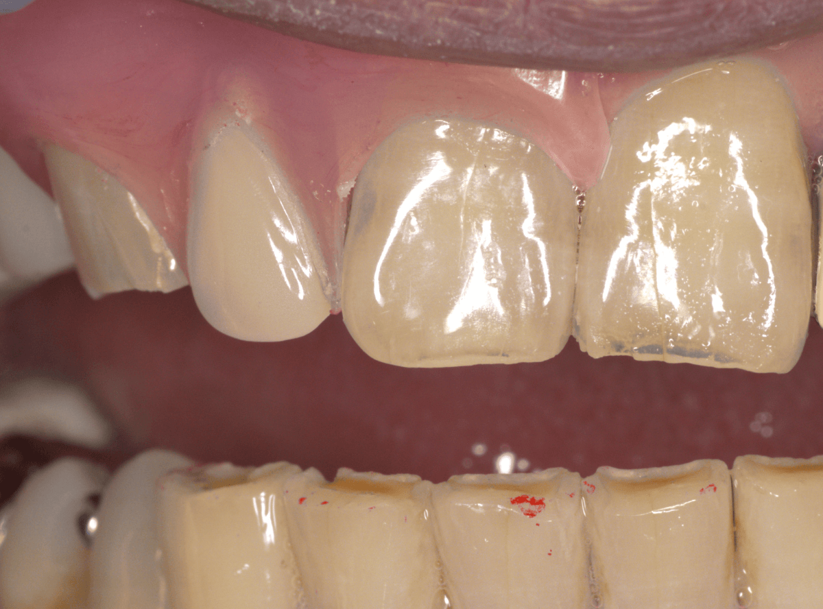 ノンクラスプ・デンチャー画像-5