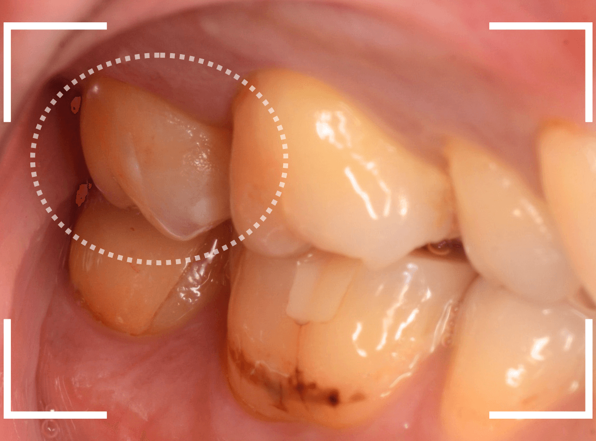 セラミック治療(インレー)30-1
