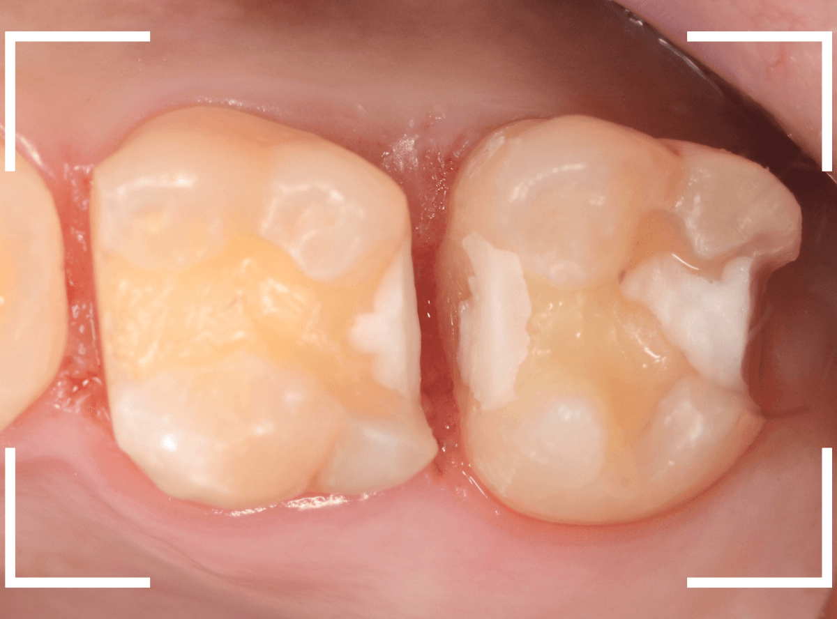 セラミック治療(インレー)31-2