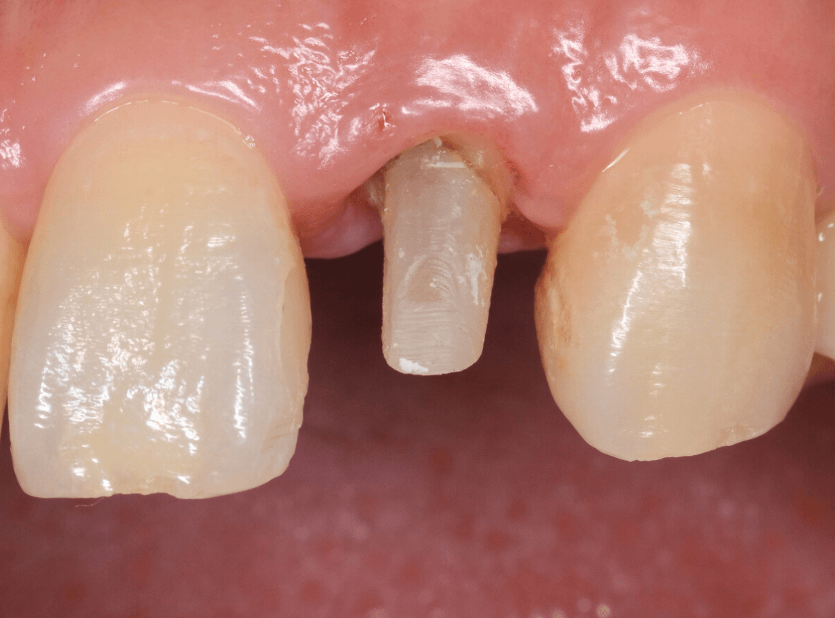 「前歯が折れた」という患者さん-5