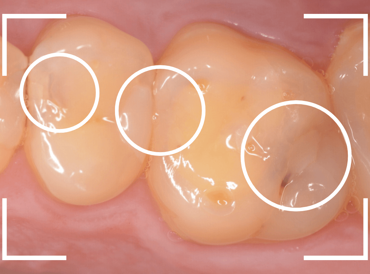 セラミック治療(インレー)24-3