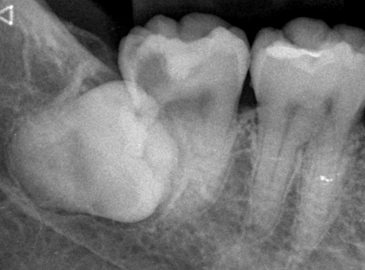 つめものの下の深い深い虫歯11-1