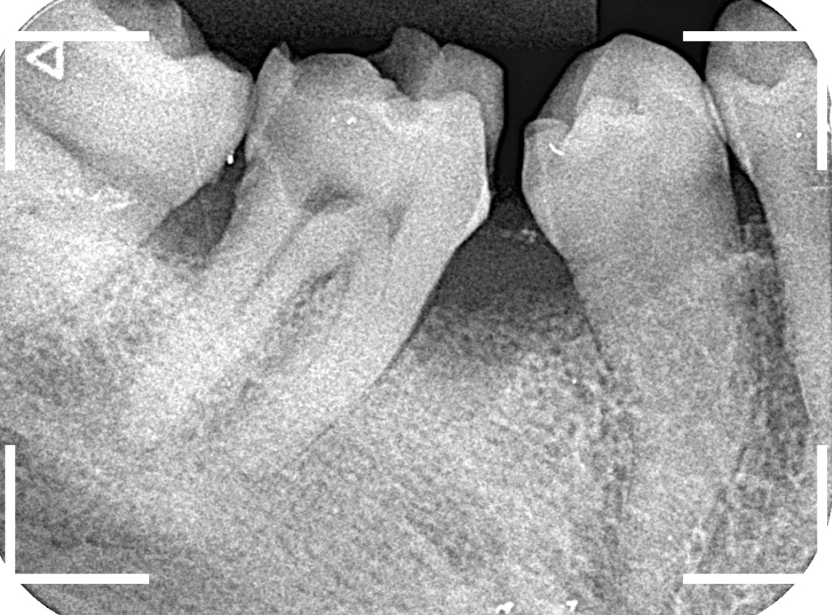 つめものの下の深い深い虫歯12-6