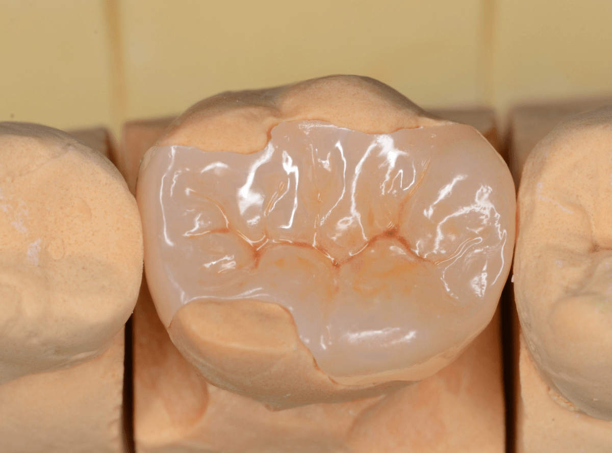 セラミック治療(インレー)12-3