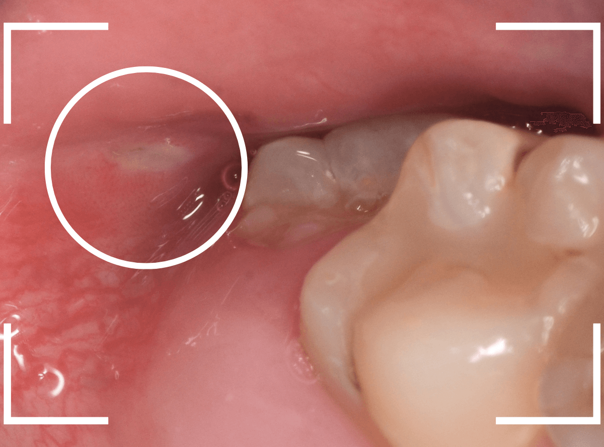 おやしらずの抜歯23-1