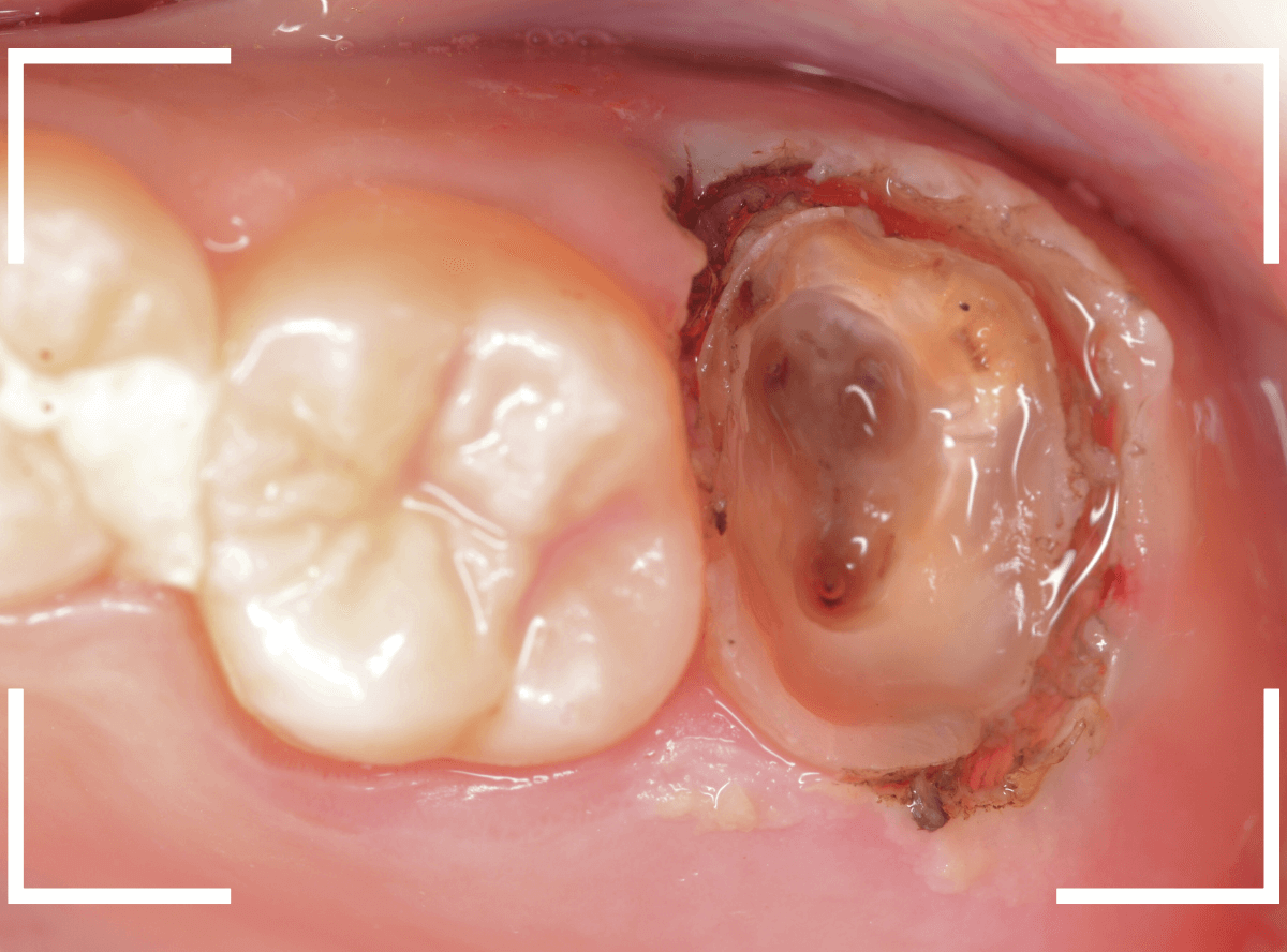 セラミック治療(クラウン・奥歯)10-3
