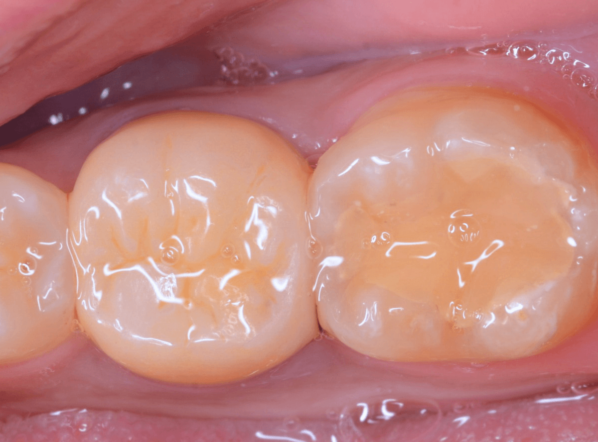 つめものが取れた歯の治療の画像-8