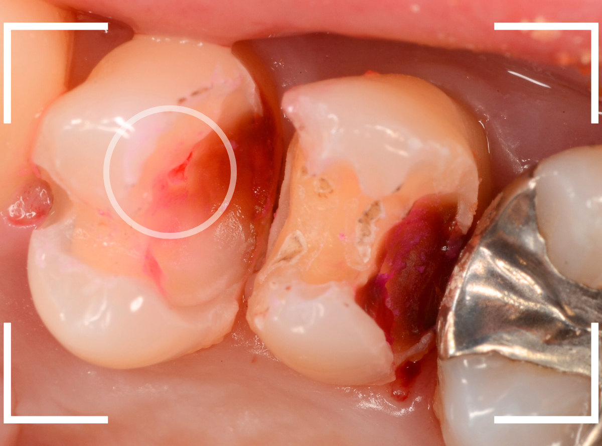 歯と歯の間の虫歯21-1