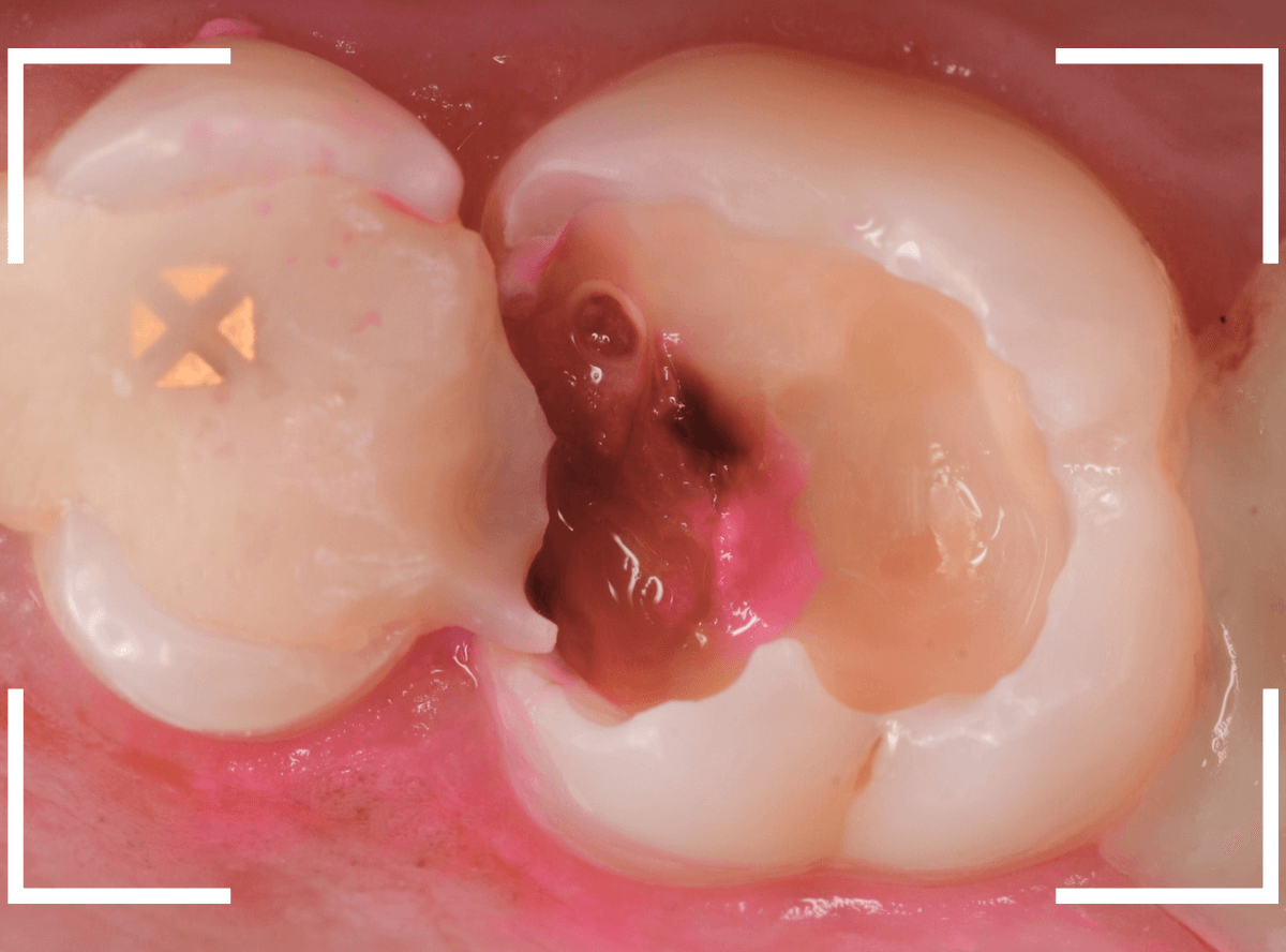 つめものの下の深い深い虫歯20-3