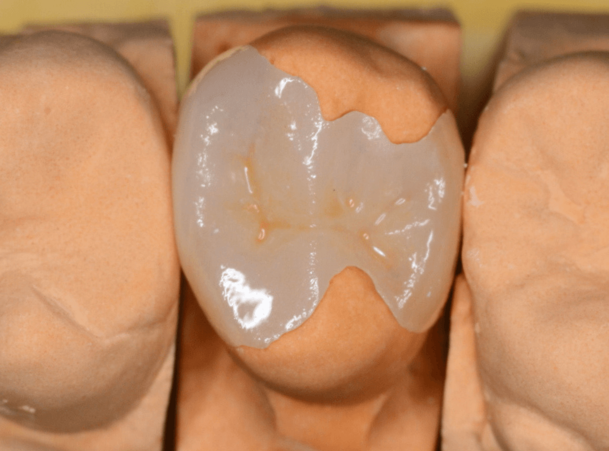 セラミック治療(インレー)15-3