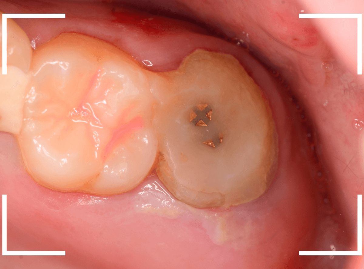 セラミック治療(クラウン・奥歯)10-1