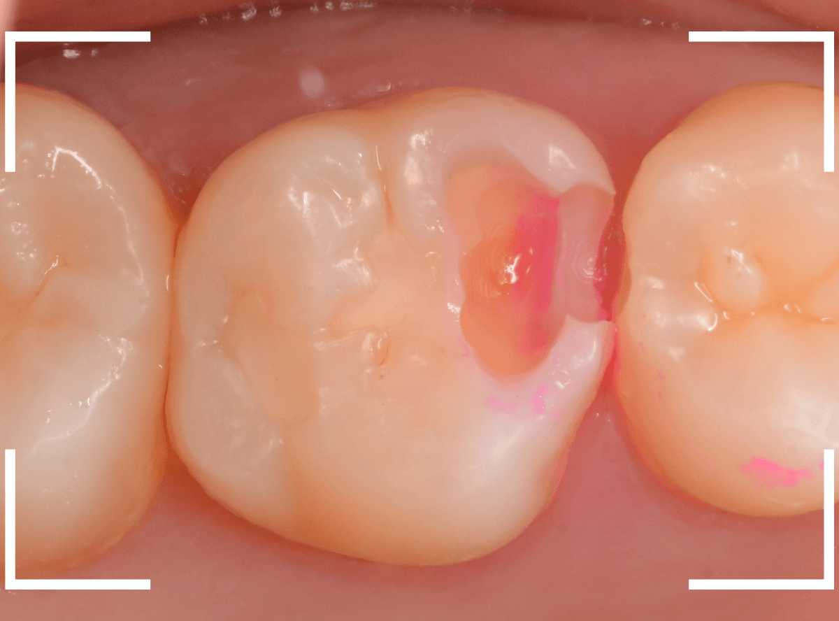 歯と歯の間の虫歯24-4