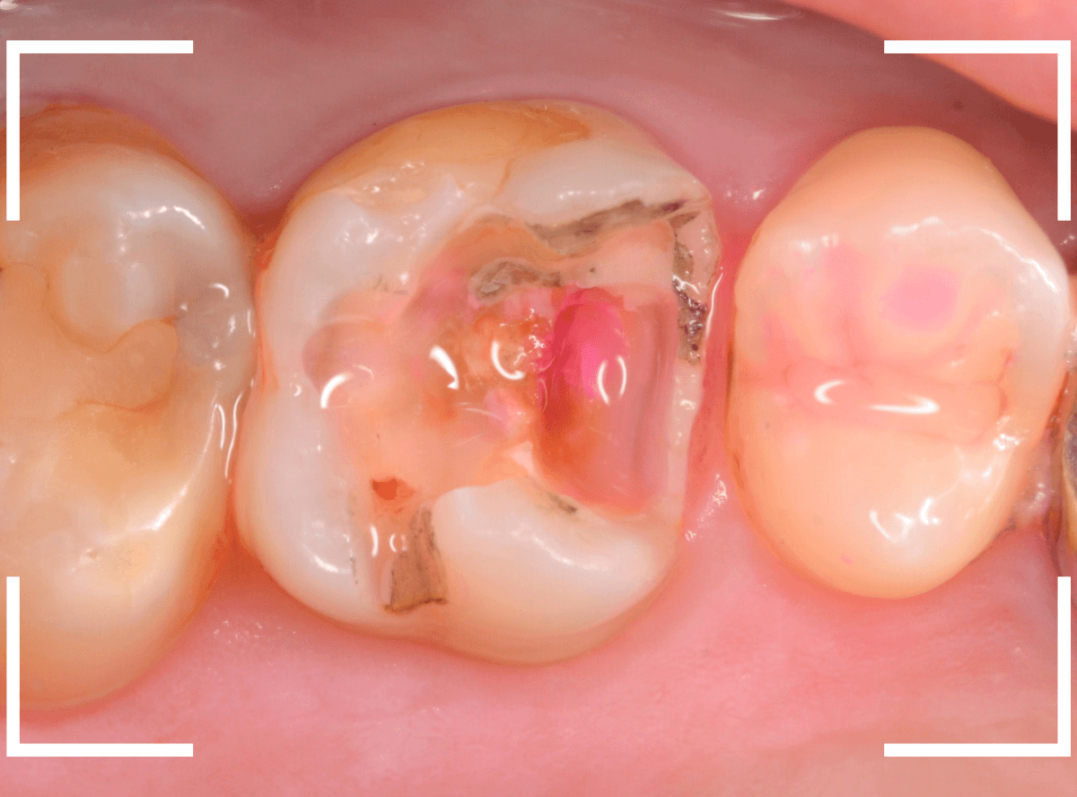 つめものの下の深い虫歯(画像)10-1