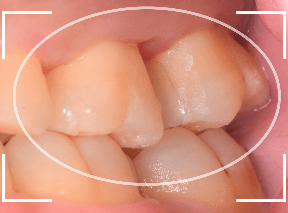 セラミック治療(インレー)31-5