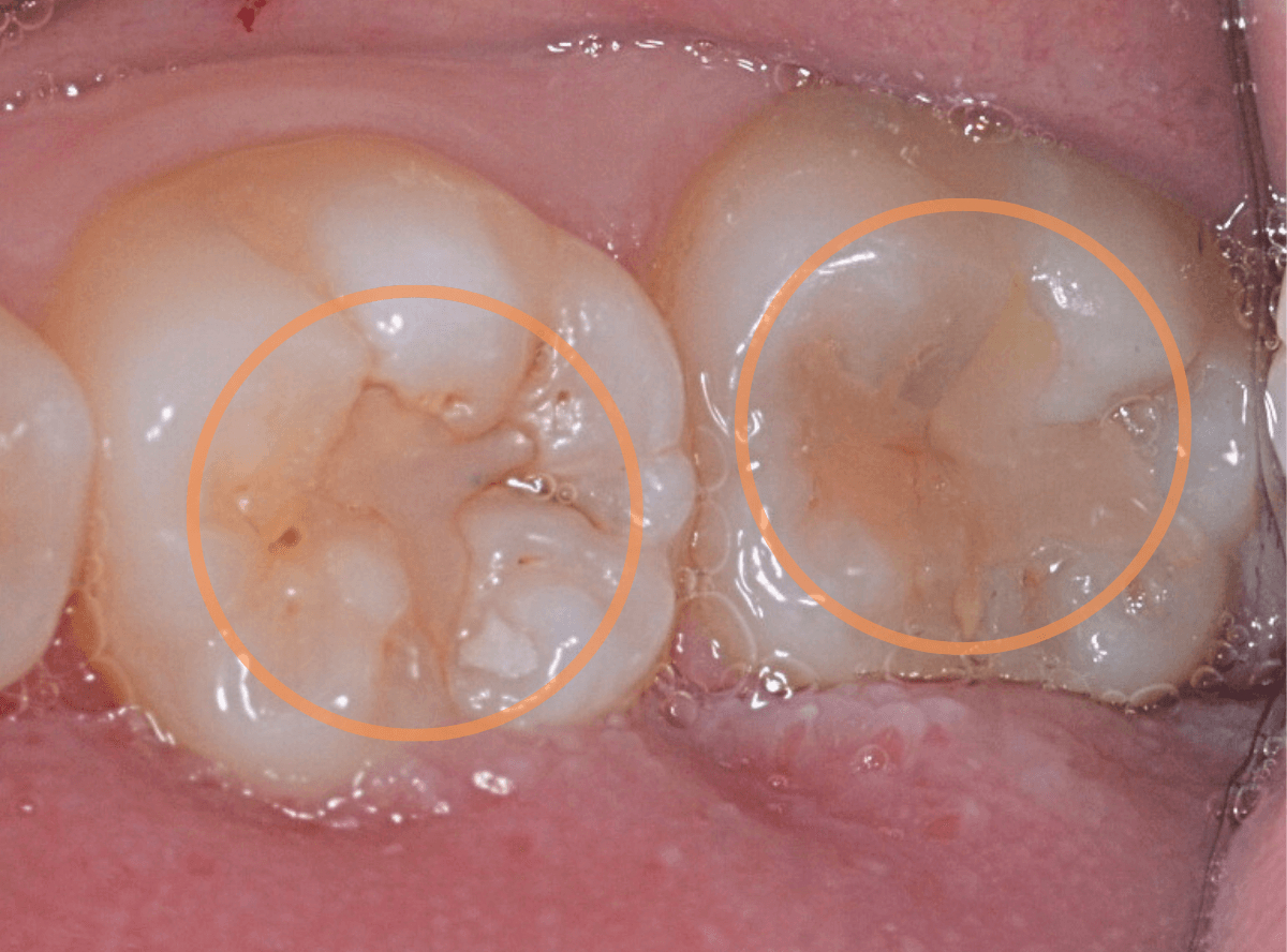 コンポジットレジン治療3-5