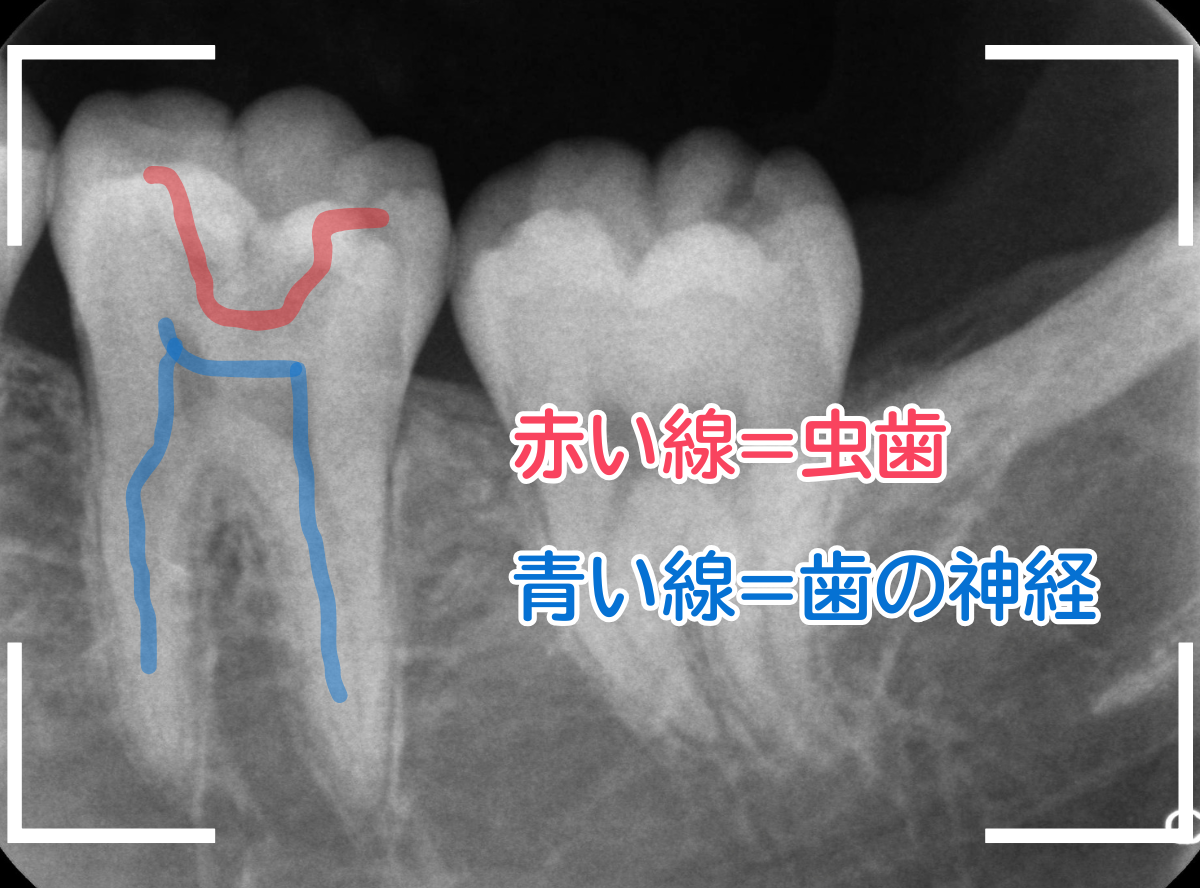 小窩裂溝う蝕5-2