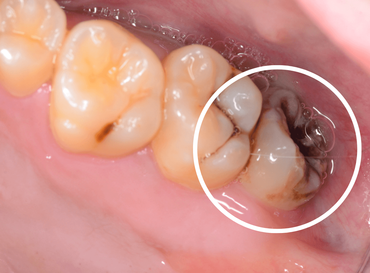 おやしらずの抜歯1-1