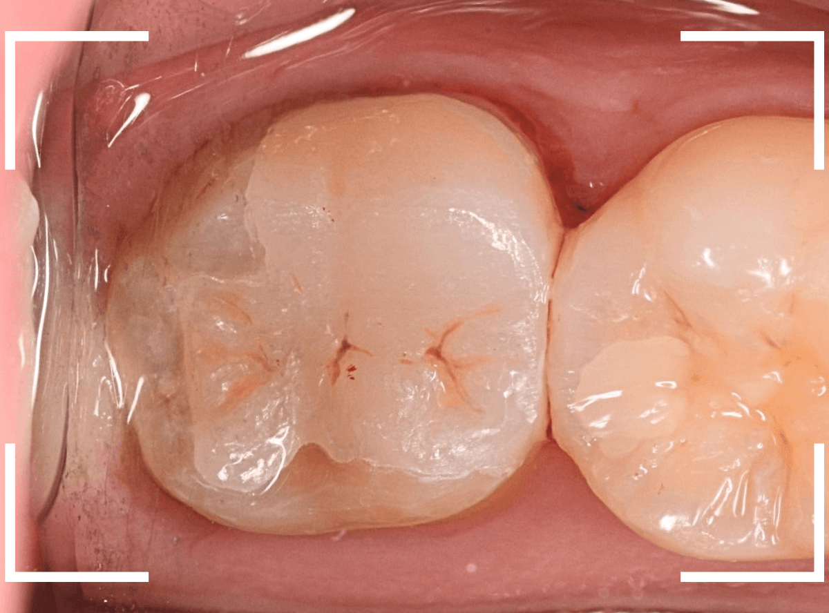 セラミック治療(インレー)20-4