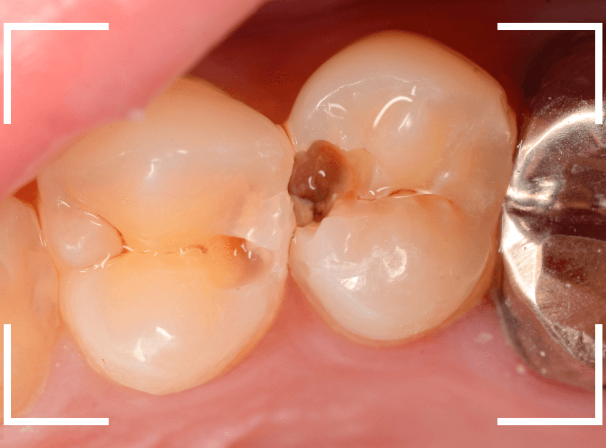 歯と歯の間の虫歯22-3
