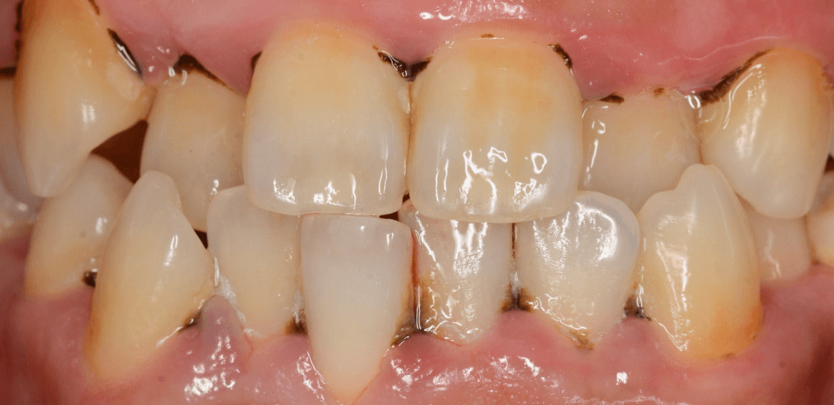 歯肉の中の歯石（歯肉縁下歯石）除去(画像）4-1