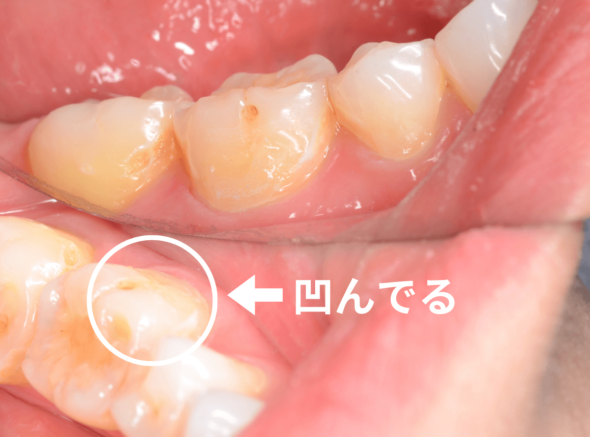 知覚過敏の画像1-2