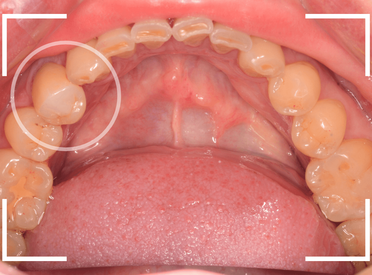 セラミック治療(クラウン・奥歯)11-6