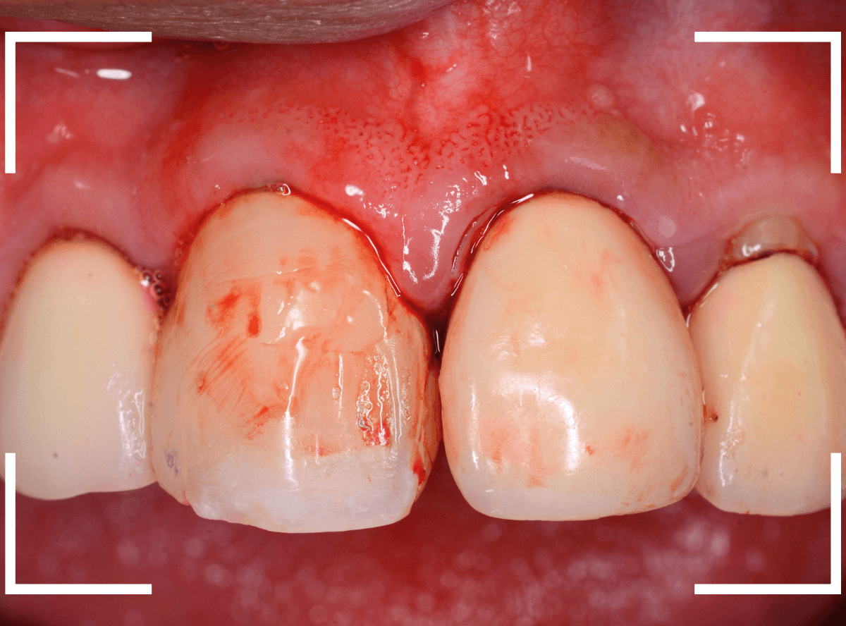 歯肉の中の歯石（歯肉縁下歯石）除去(画像）5-2