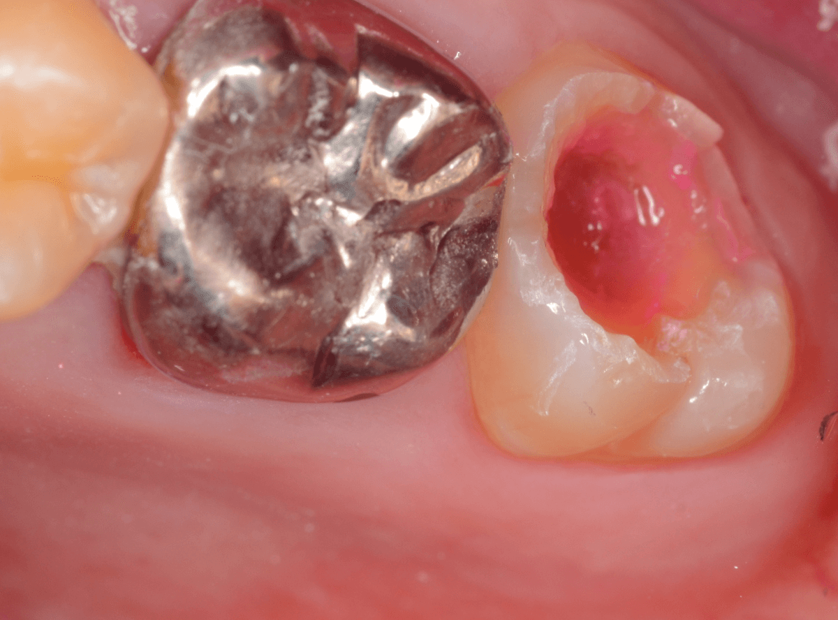 気づかないうちに深い虫歯-1