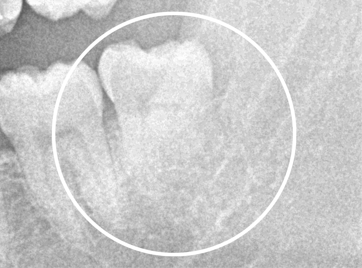 おやしらずの抜歯6-2