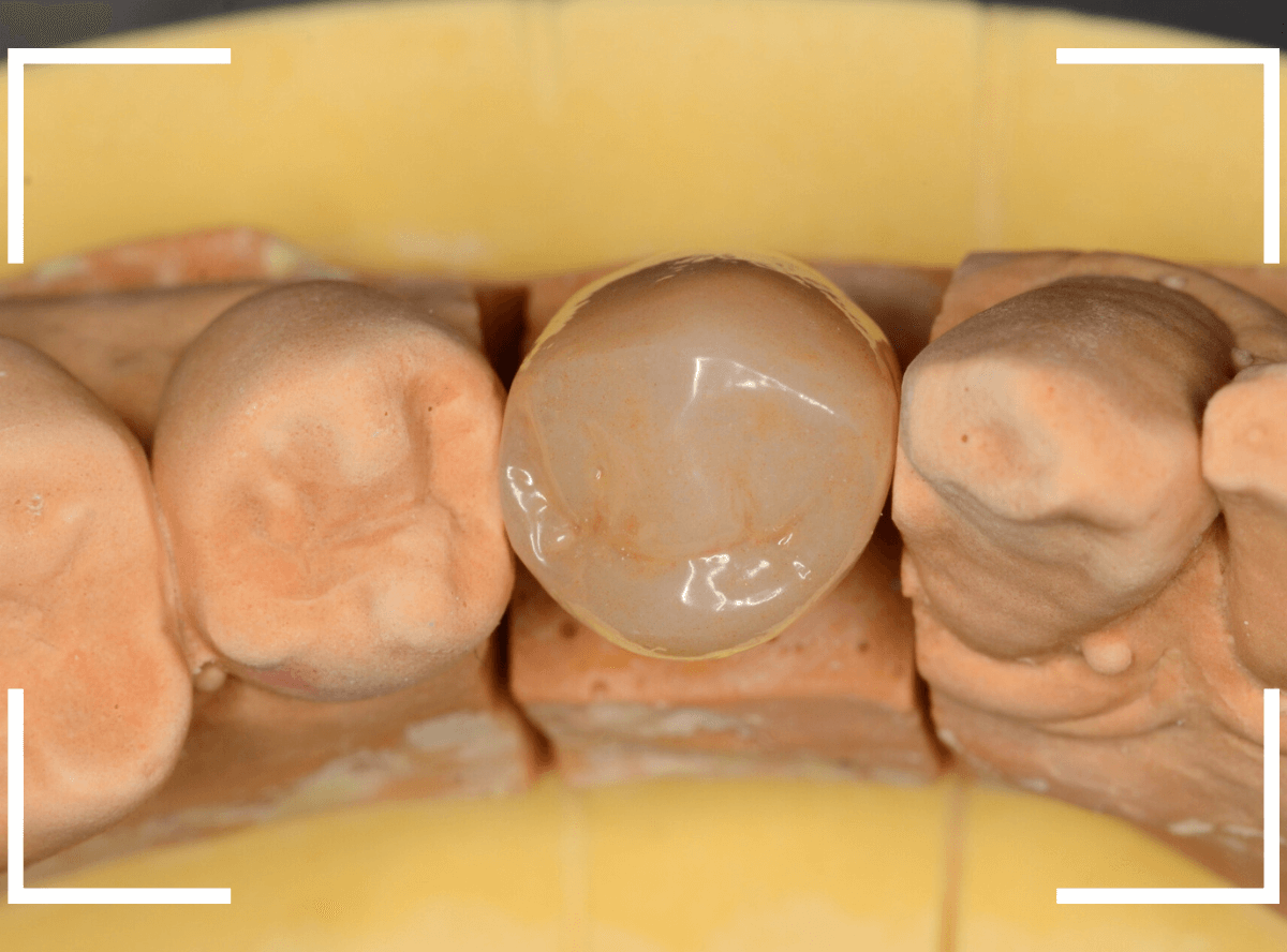 セラミック治療(クラウン・奥歯)11-3