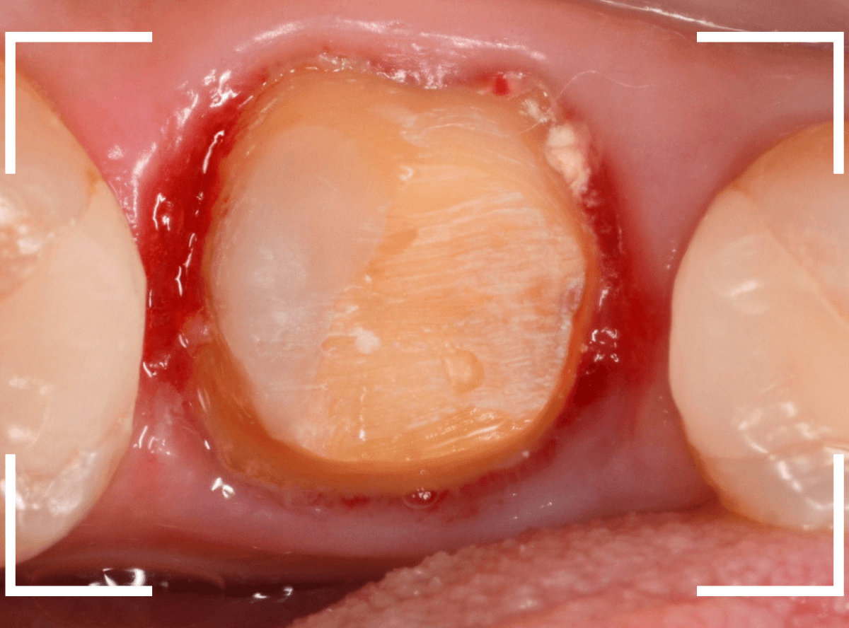 セラミック治療(クラウン・奥歯)7-4