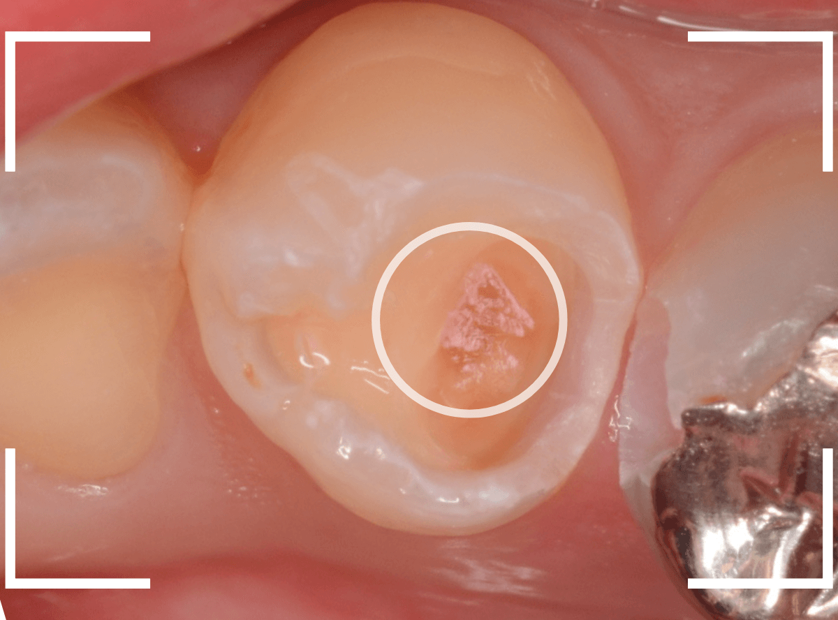 歯と歯の間の虫歯6-5