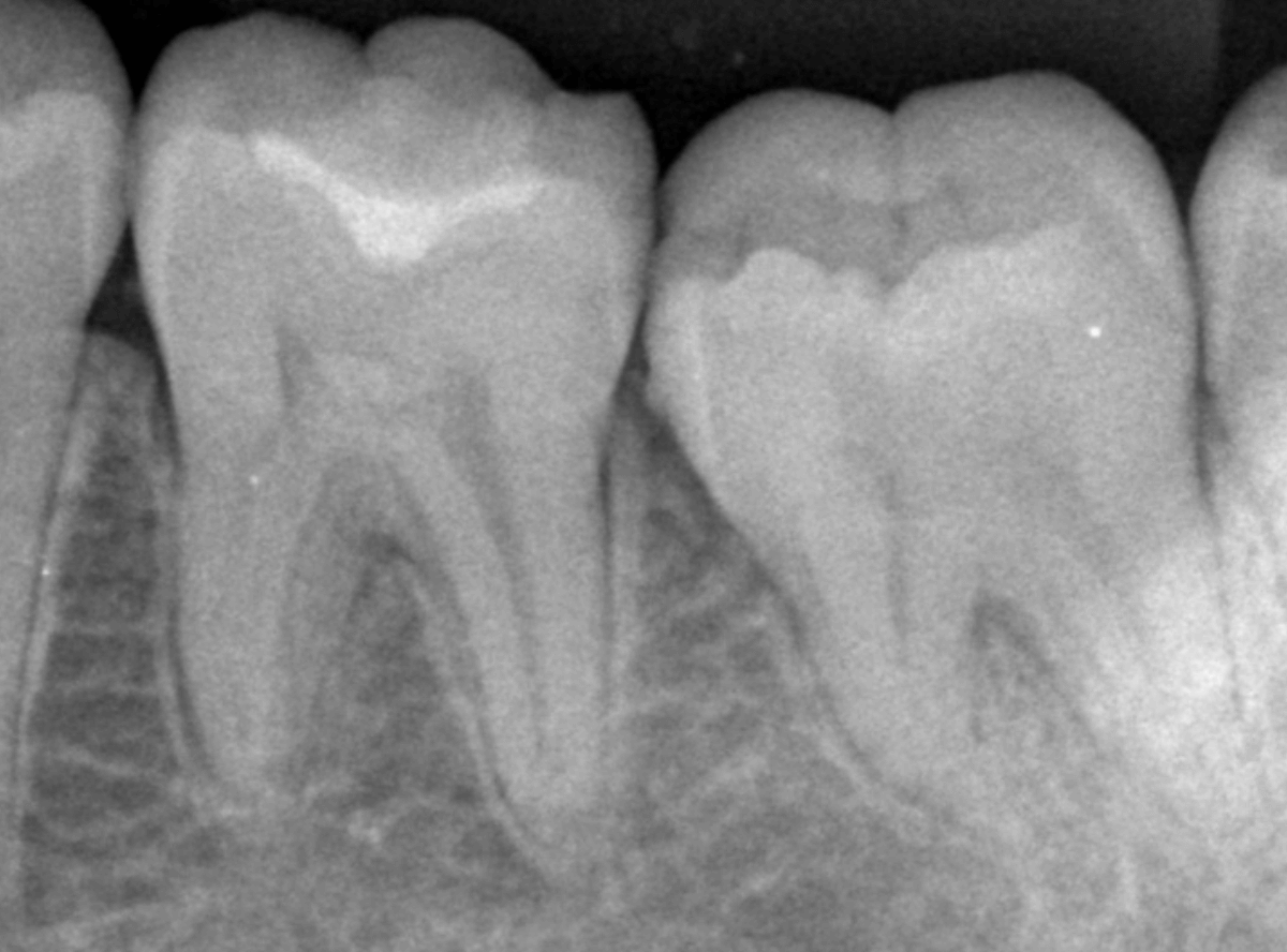 レントゲンでわかりづらい虫歯3-2