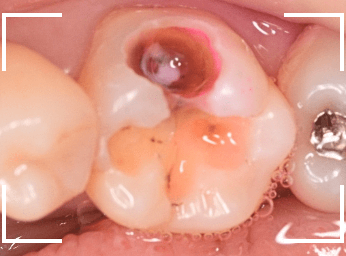 つめものの下の深い深い虫歯20-1