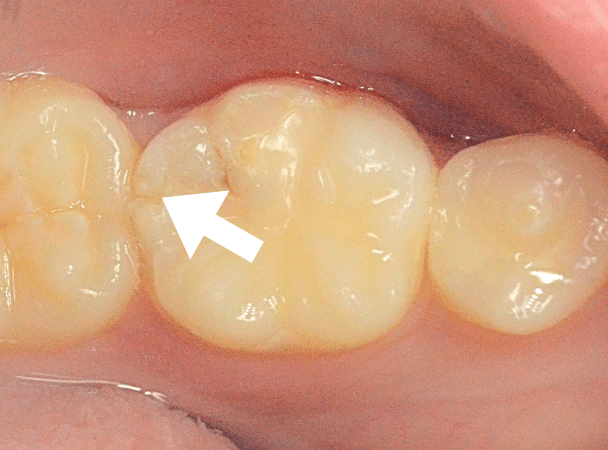セラミック治療(インレー)7-1