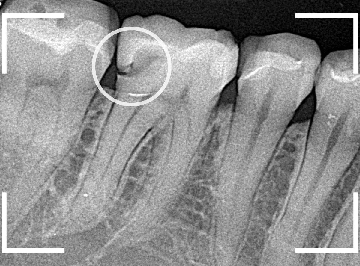 セラミック治療(クラウン・奥歯)7-2