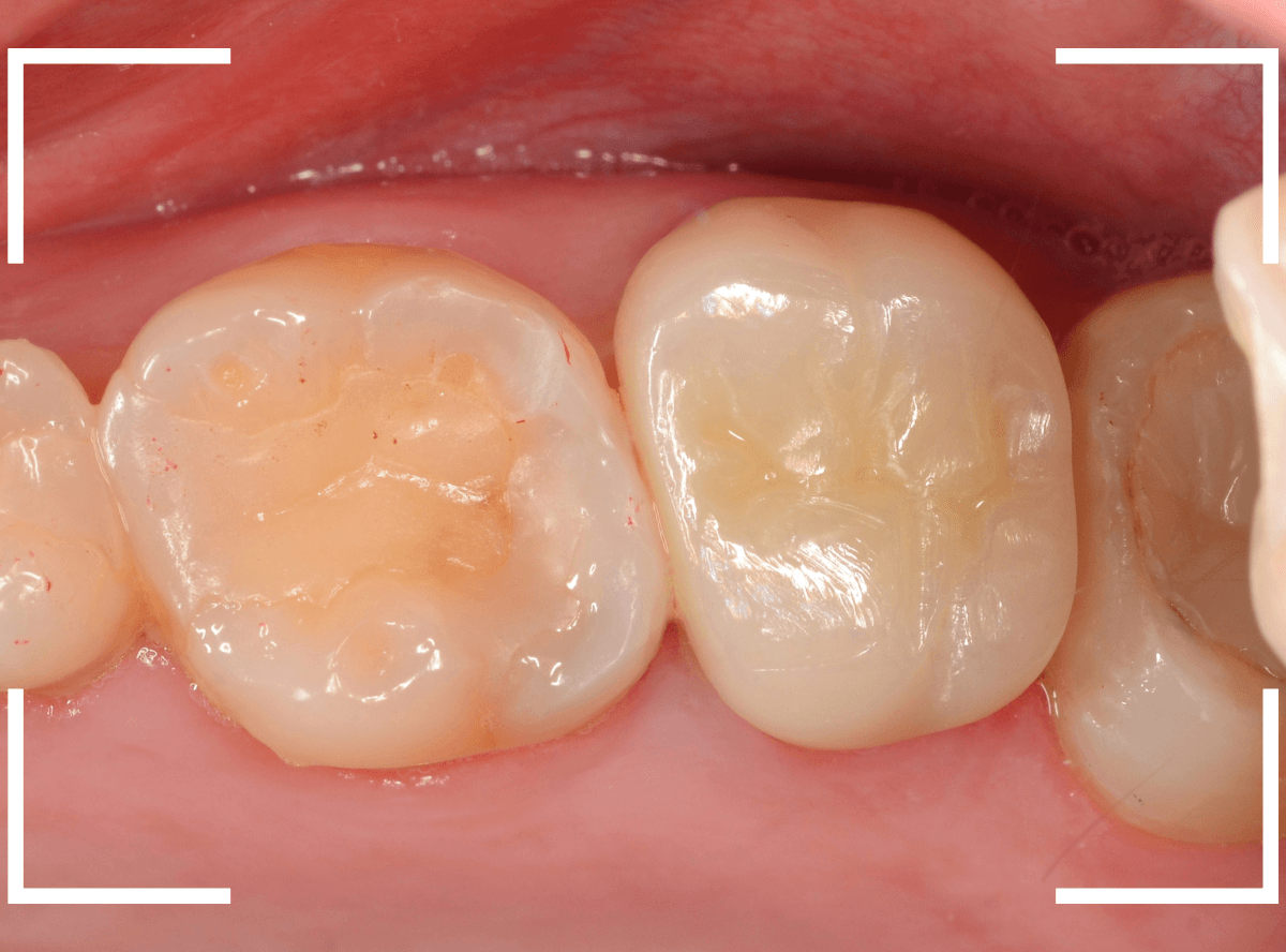 メタル・フリー治療の実際21-5