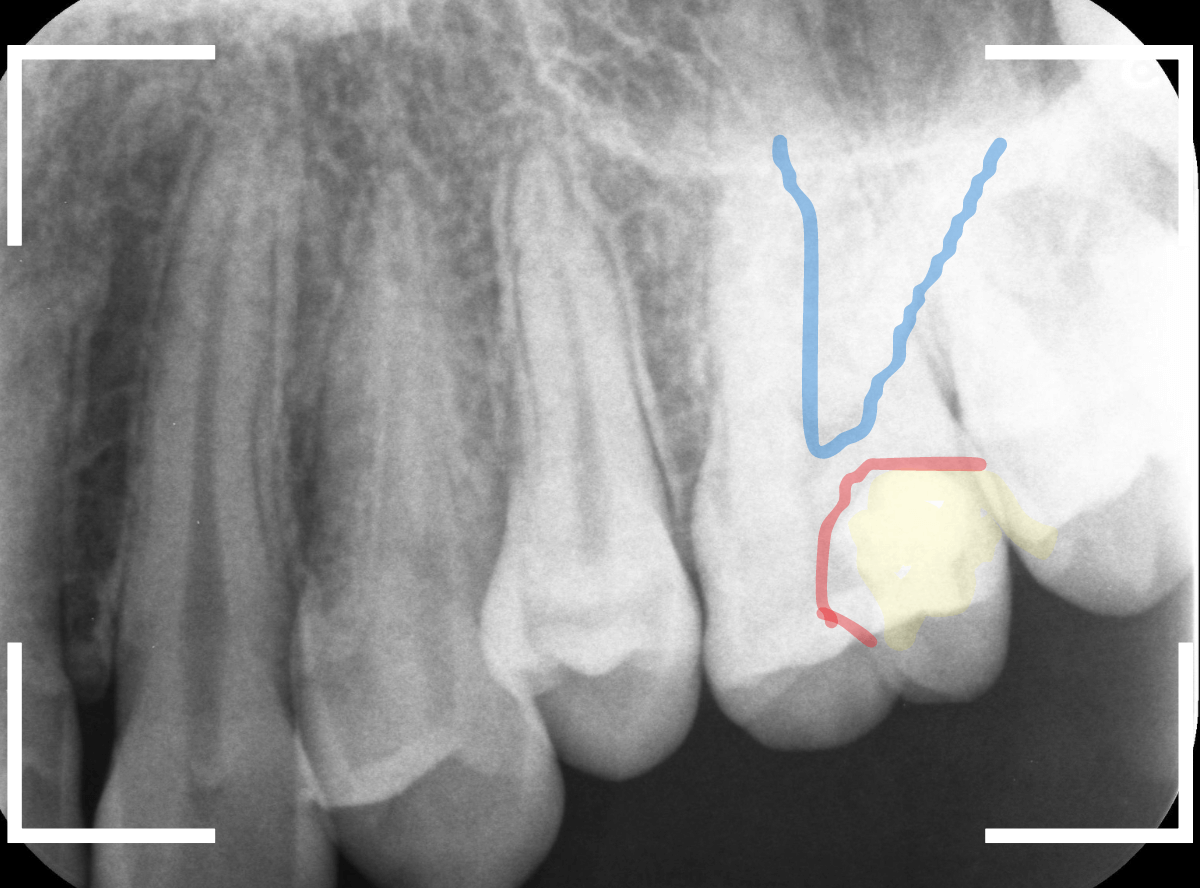 つめものの下の深い深い虫歯20-1