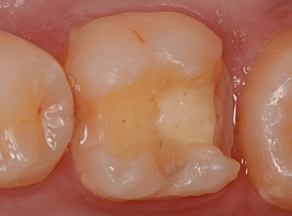 セラミック治療(インレー)10-1