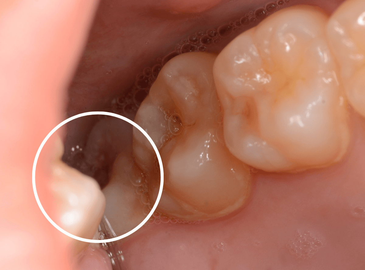 おやしらずの抜歯3-2
