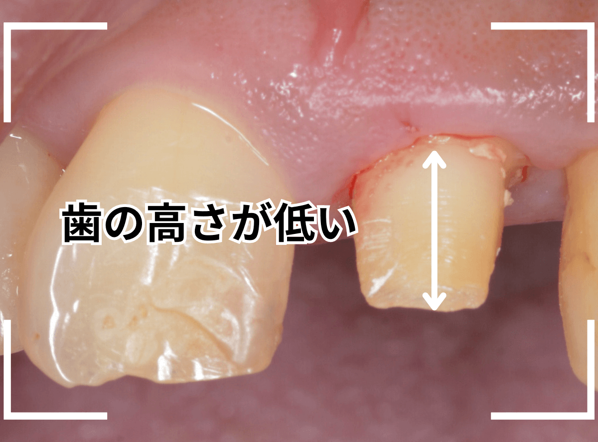 セラミック治療(前歯・クラウン)5-6