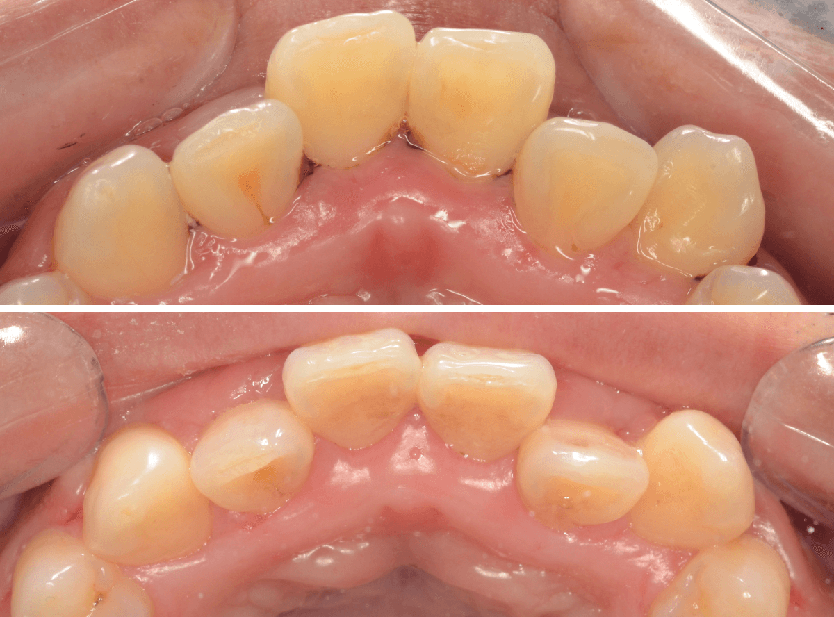歯肉の中の歯石（歯肉縁下歯石）除去(画像）4-5