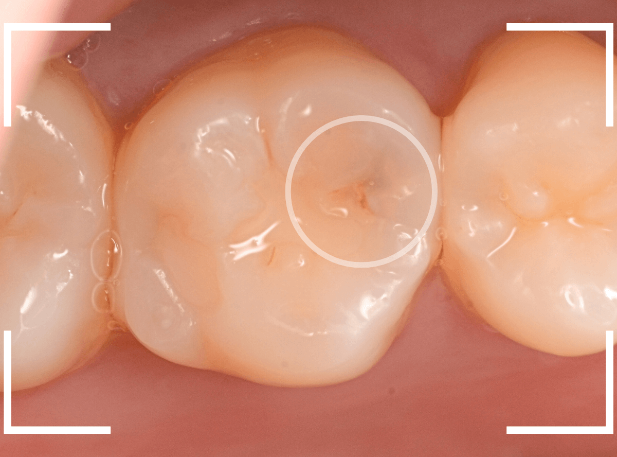 歯と歯の間の虫歯24-1